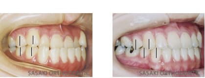 ●上下歯列の前後のバランスを整える（1歯対2歯の関係の確立）