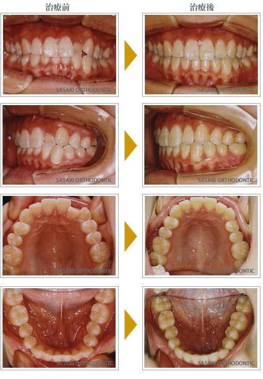 部分矯正上顎前歯の一部反対咬合症例